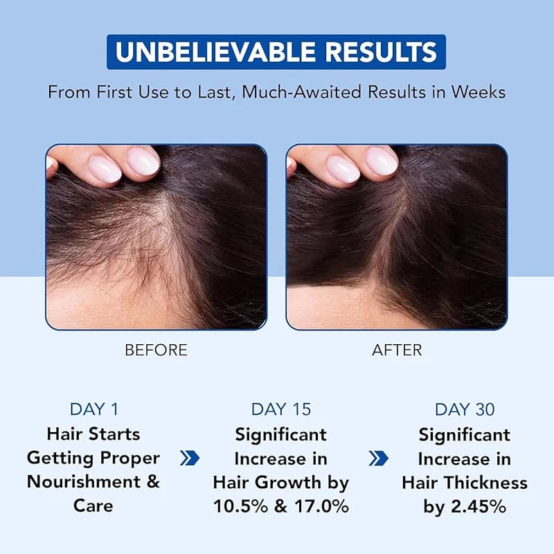 Botanic Hearth Hair Oil for Hair Growth | Rosemary Oil for Hair Growth — image 6